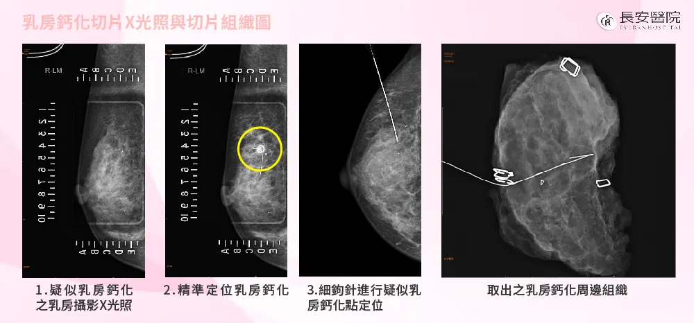 乳房攝影疑似鈣化點立體定位微創手術