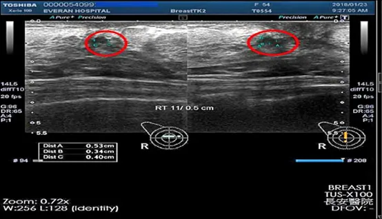 乳癌雙標靶加化療輔助治療