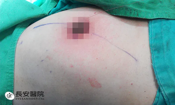 整型式乳房保留手術