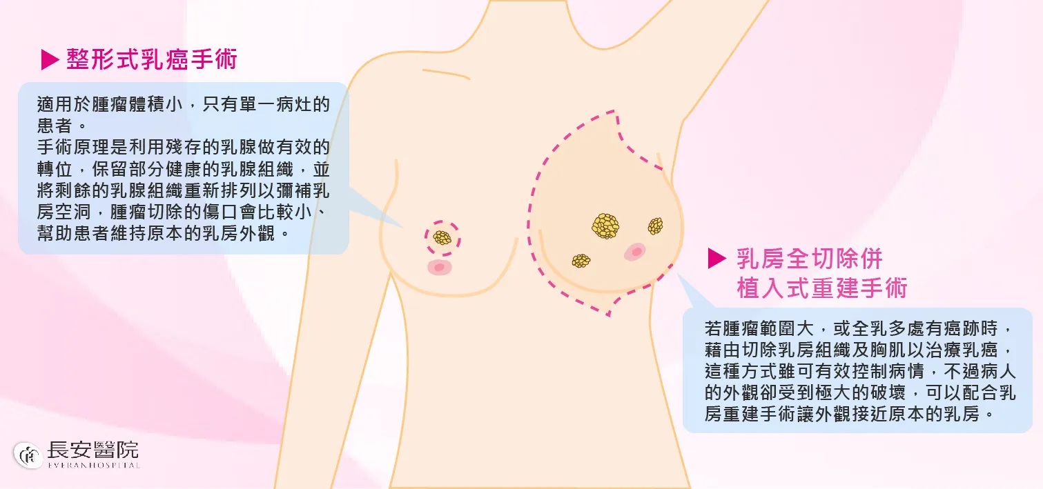 整型式乳房保留手術