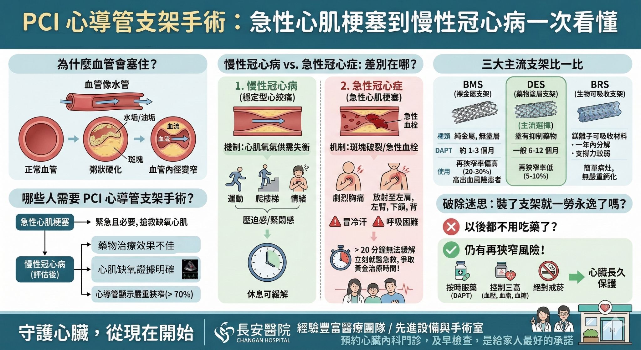 PCI 心導管支架手術是什麼?急性心肌梗塞到慢性冠心病一次看懂 PCI 心導管支架手術是什麼?急性心肌梗塞到慢性冠心病一次看懂