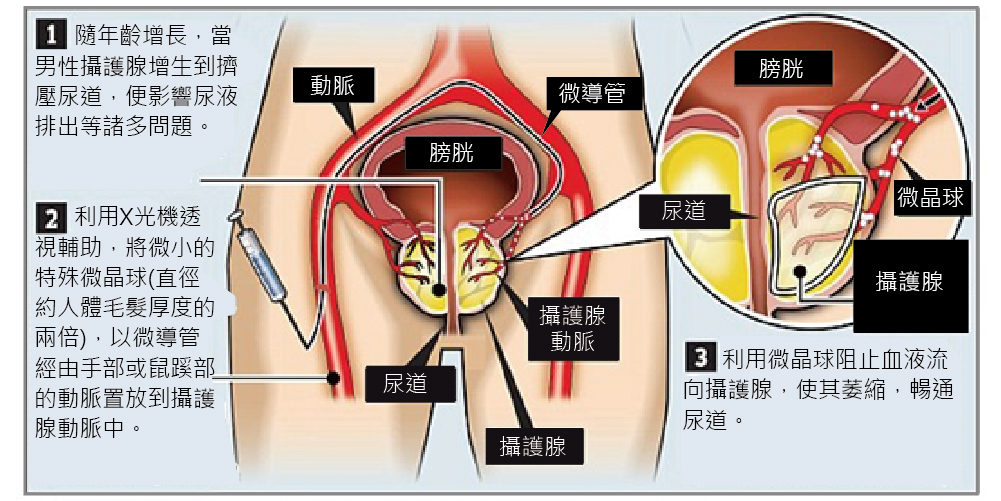攝護腺動脈栓塞術(攝護腺減手術) 攝護腺動脈栓塞術(攝護腺減手術)