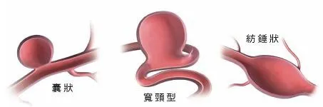 腦血管退化性疾病|中風、動脈瘤、帕金森、腦部出血、代謝性腦病變