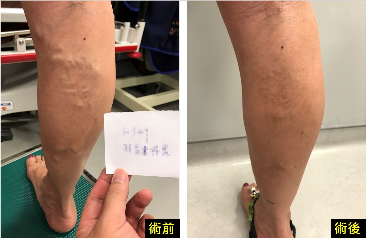 靜脈曲張嚴重恐致靜脈栓塞 需早期介入治療