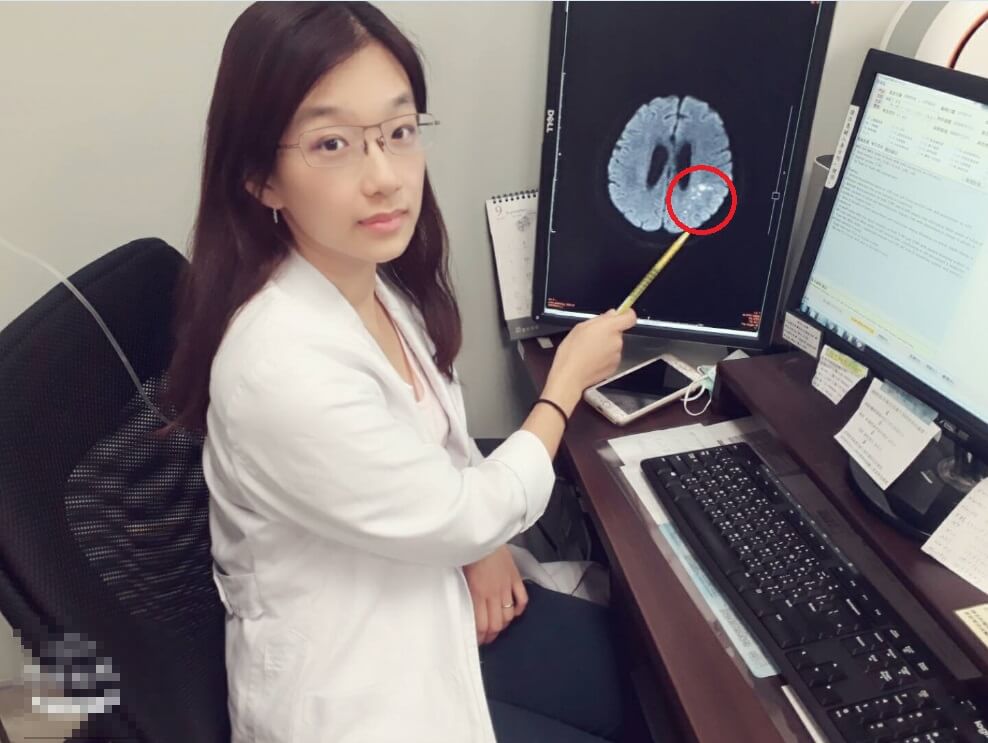 7旬嬤認知功能退化有如失智 原來是梗塞性腦中風作祟