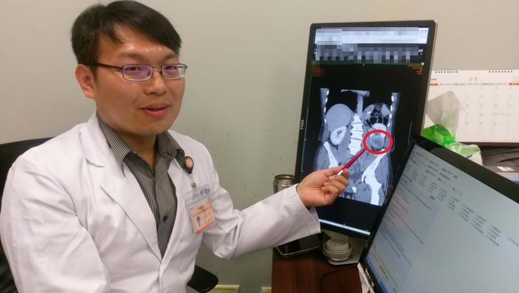 驚!「寂靜的殺手」腎細胞癌年輕化 四旬壯男尿潛血 罹腎細胞癌切除左腎