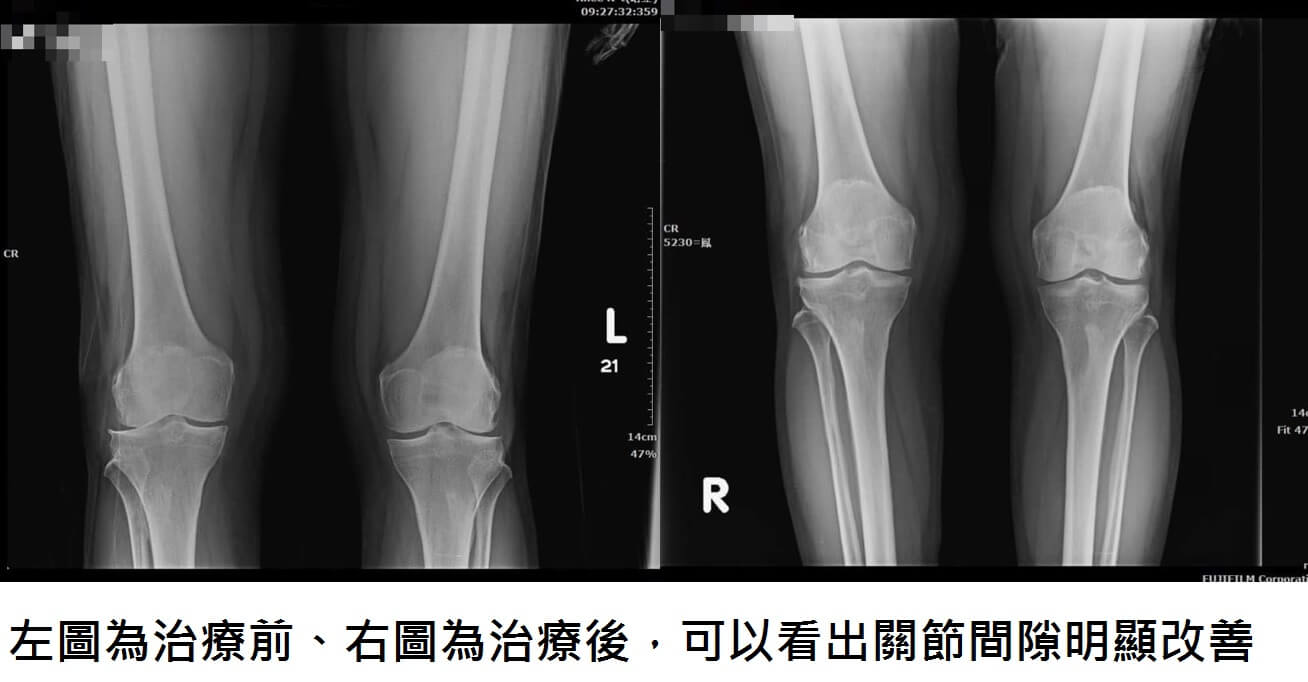 7旬婦用增生療法，為關節庝痛畫下句點!