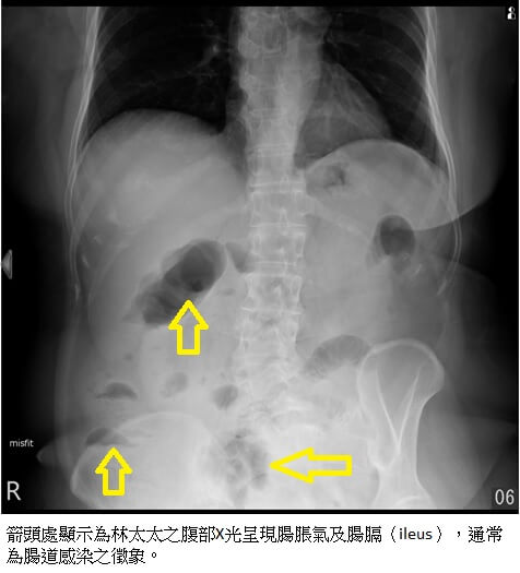 中秋烤肉這樣做，避免急性腸胃炎找上門!