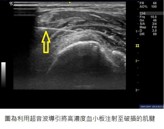 手高舉肩就痛! 醫說  它是常見的肩膀隱藏殺手