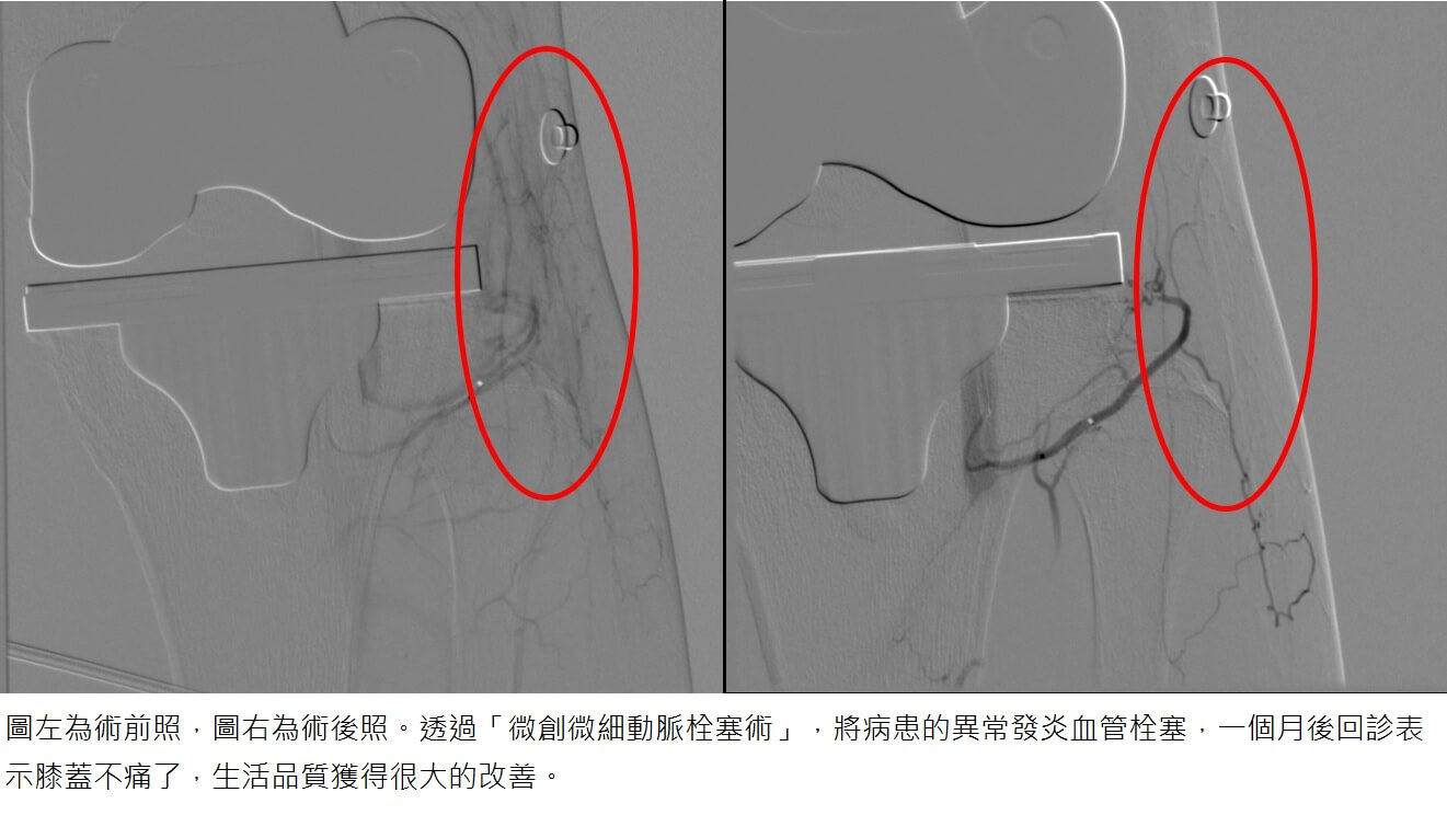 「微細動脈栓塞術」解決長期關節庝痛困擾