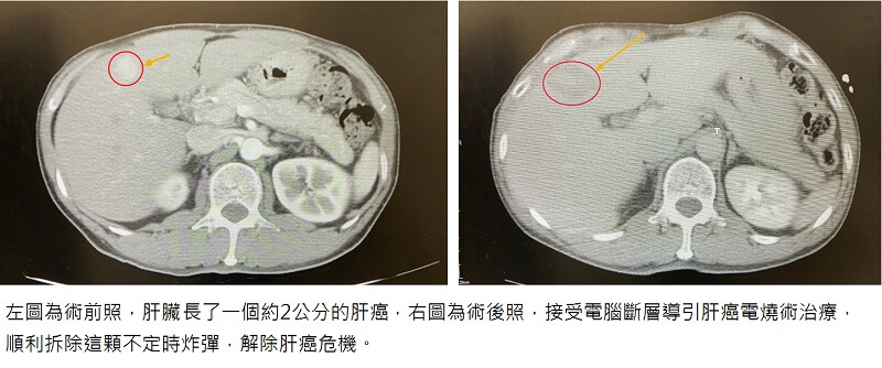 B肝帶原驚爆危機，電腦斷層導引精準拆彈!
