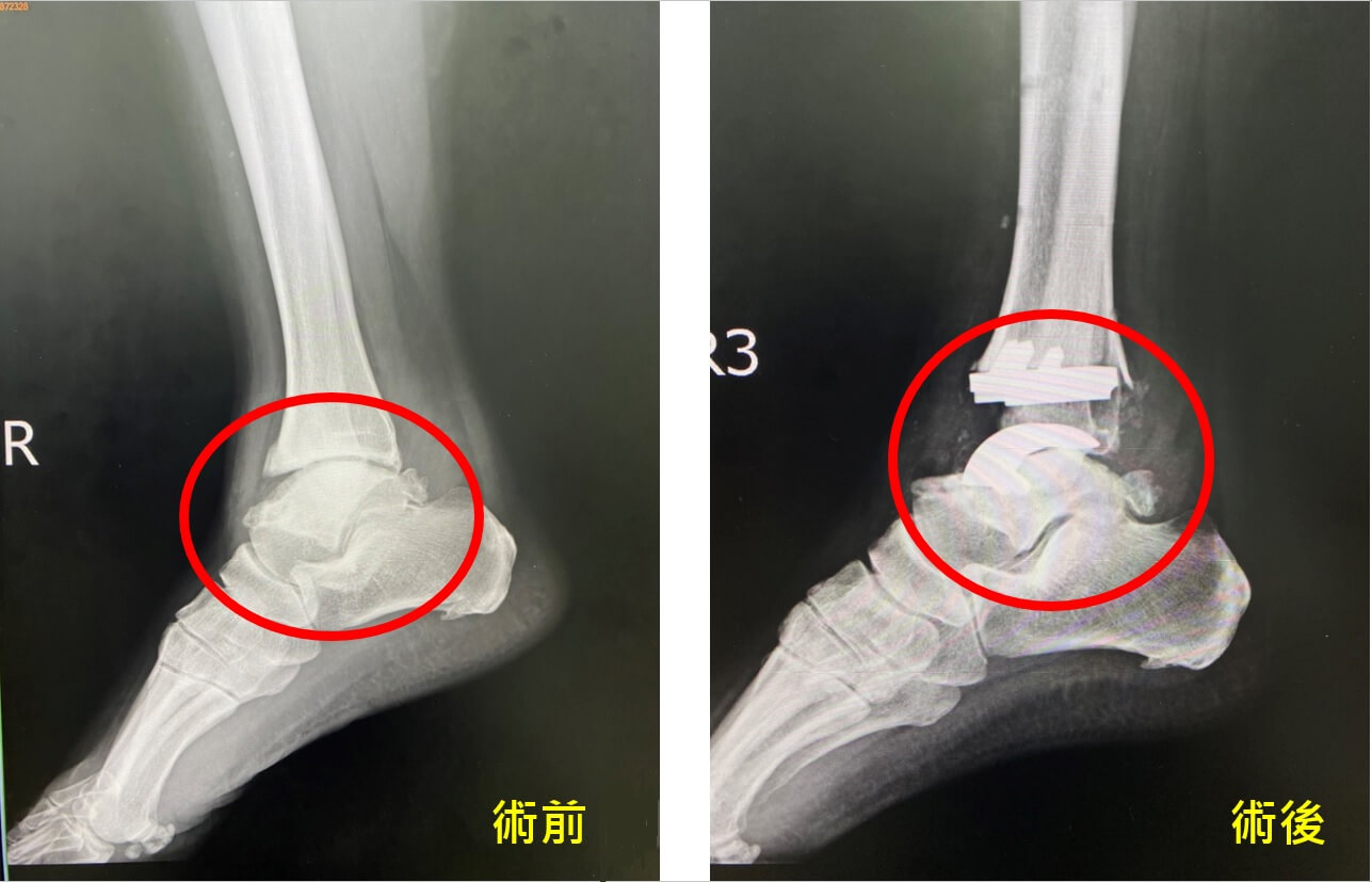 腳踝受傷未治療 「全踝關節置換術」讓婦人不再跛腳 腳踝受傷未治療 「全踝關節置換術」讓婦人不再跛腳