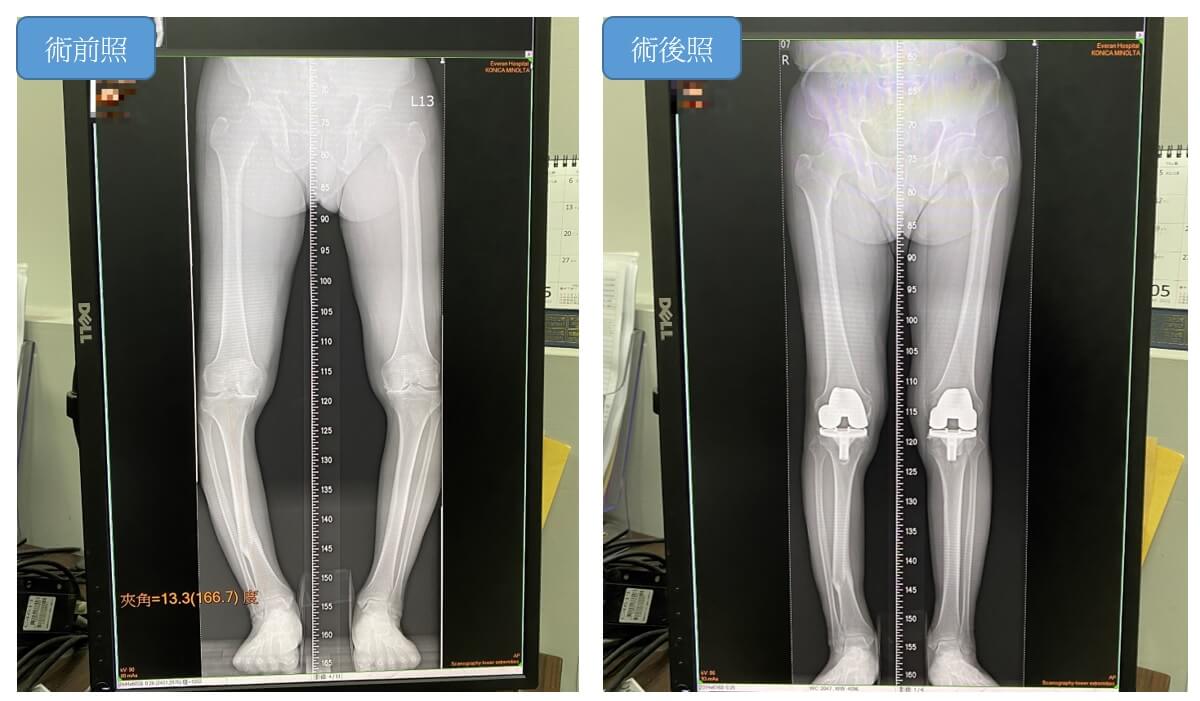7旬阿北骨折後遺症下肢變形 雙膝矯正成功擺脫多年O型腿