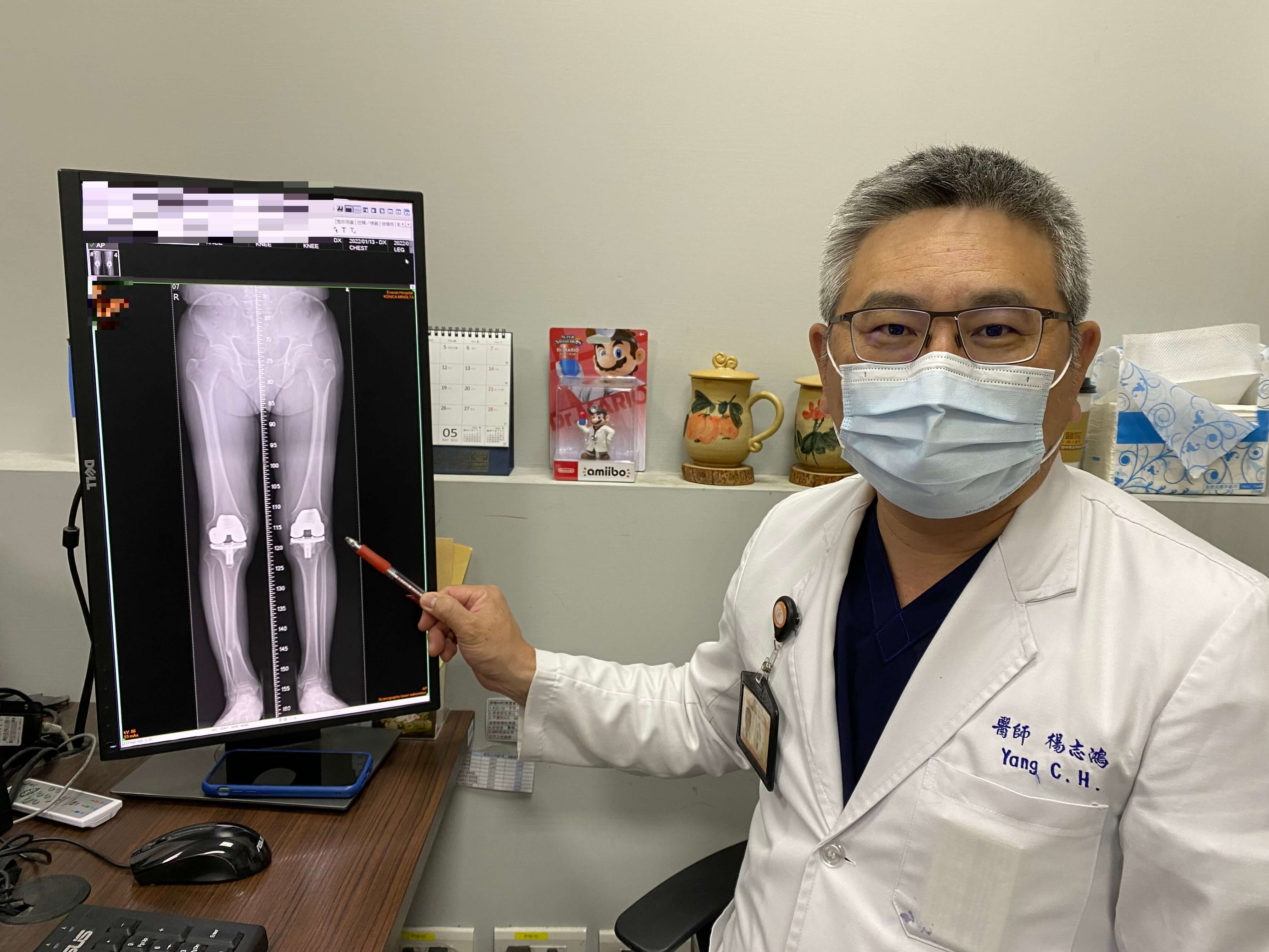 7旬阿北骨折後遺症下肢變形 雙膝矯正成功擺脫多年O型腿