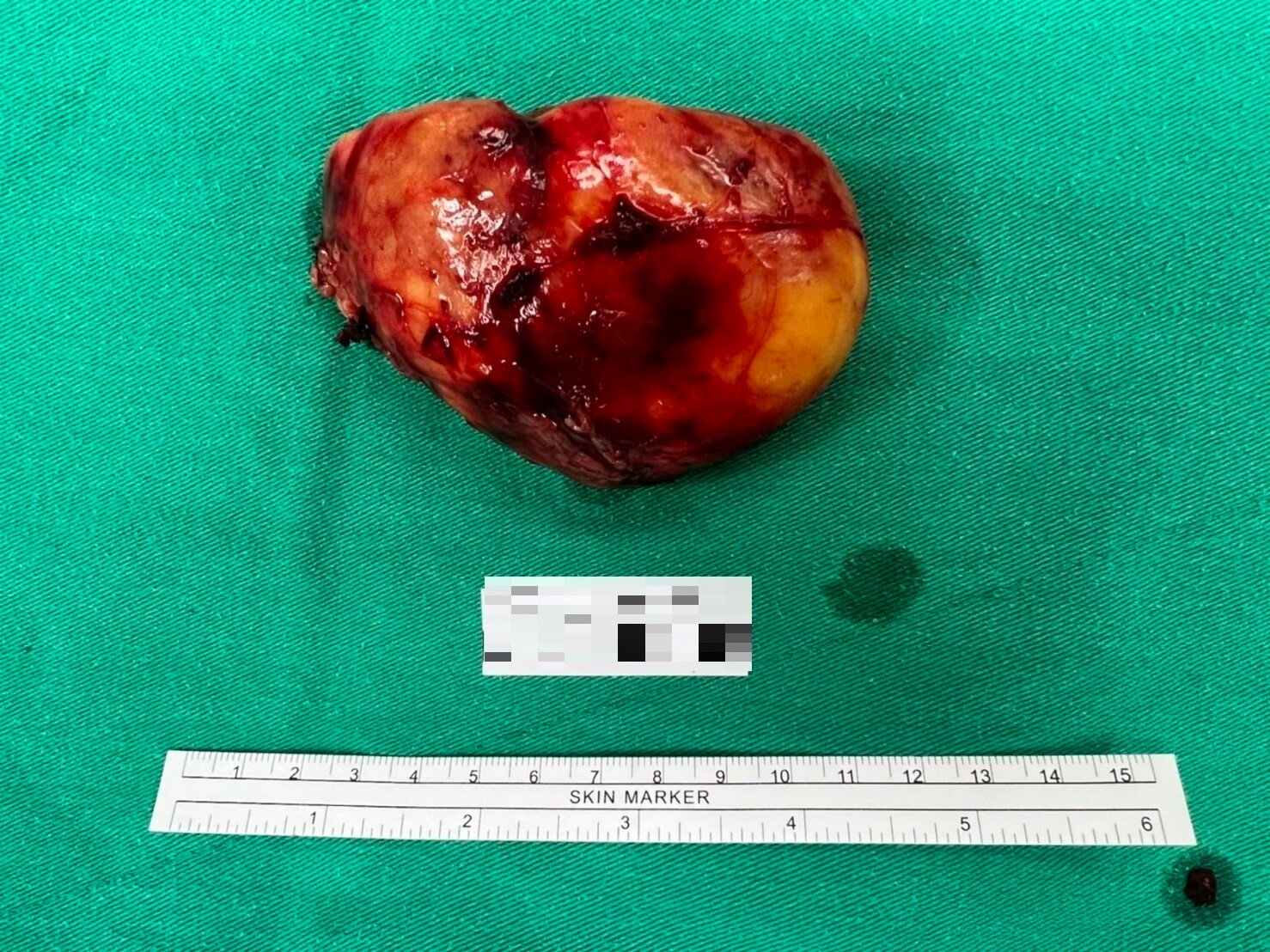 腰痛不適發現8公分腫瘤 腹腔鏡手術保腎、降洗腎機率