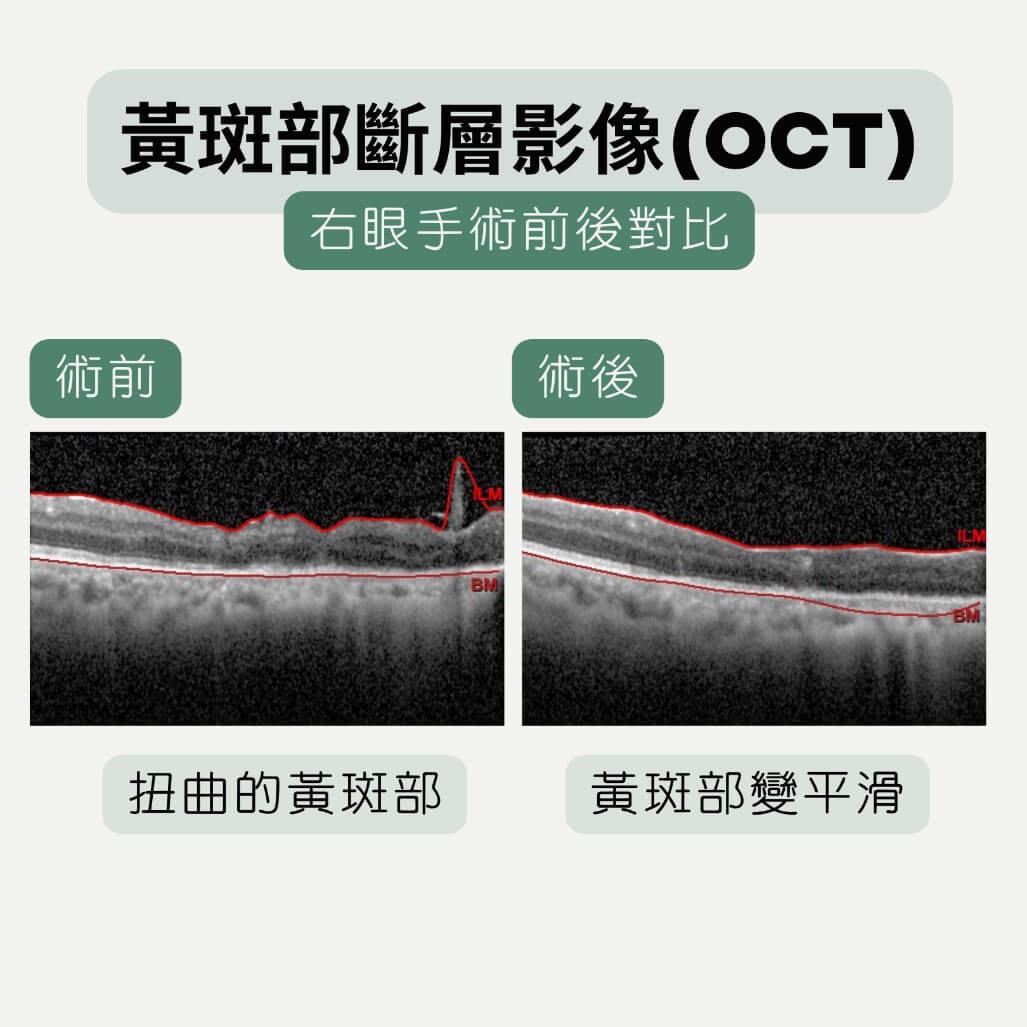 眼睛不適未找眼科診治 竟造成黃斑部永久傷害 眼睛不適未找眼科診治 竟造成黃斑部永久傷害