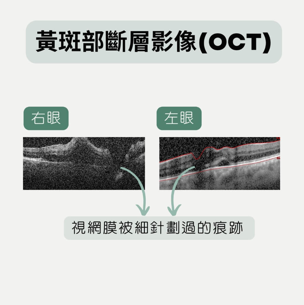 眼睛不適未找眼科診治 竟造成黃斑部永久傷害