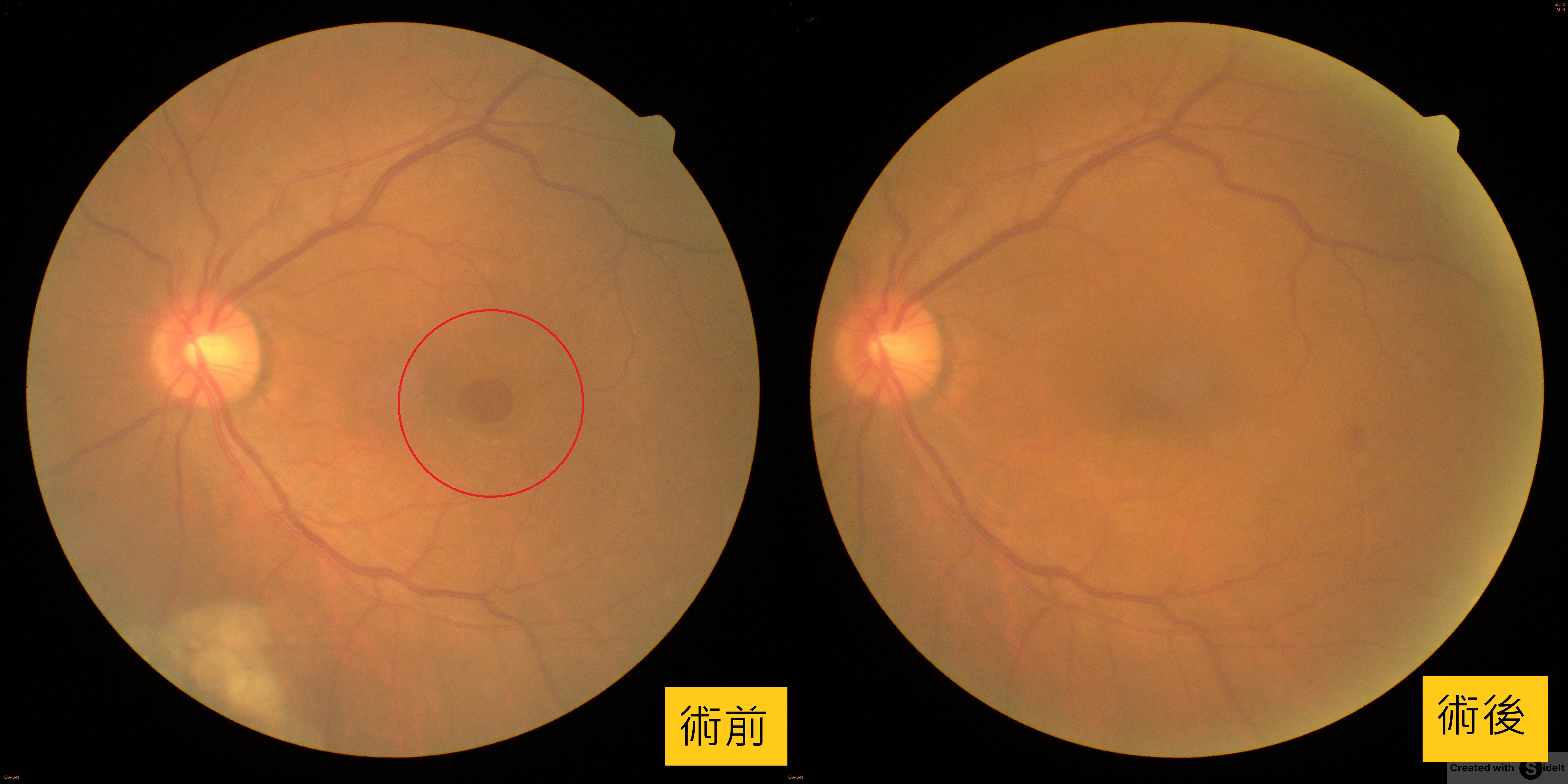 六旬翁眼前一團黑，竟是黃斑部破大洞！