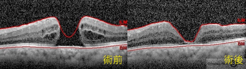 六旬翁眼前一團黑，竟是黃斑部破大洞！