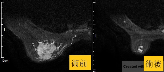 拖2年才就醫 乳癌腫瘤竟5公分大！醫師一招保住乳房外觀