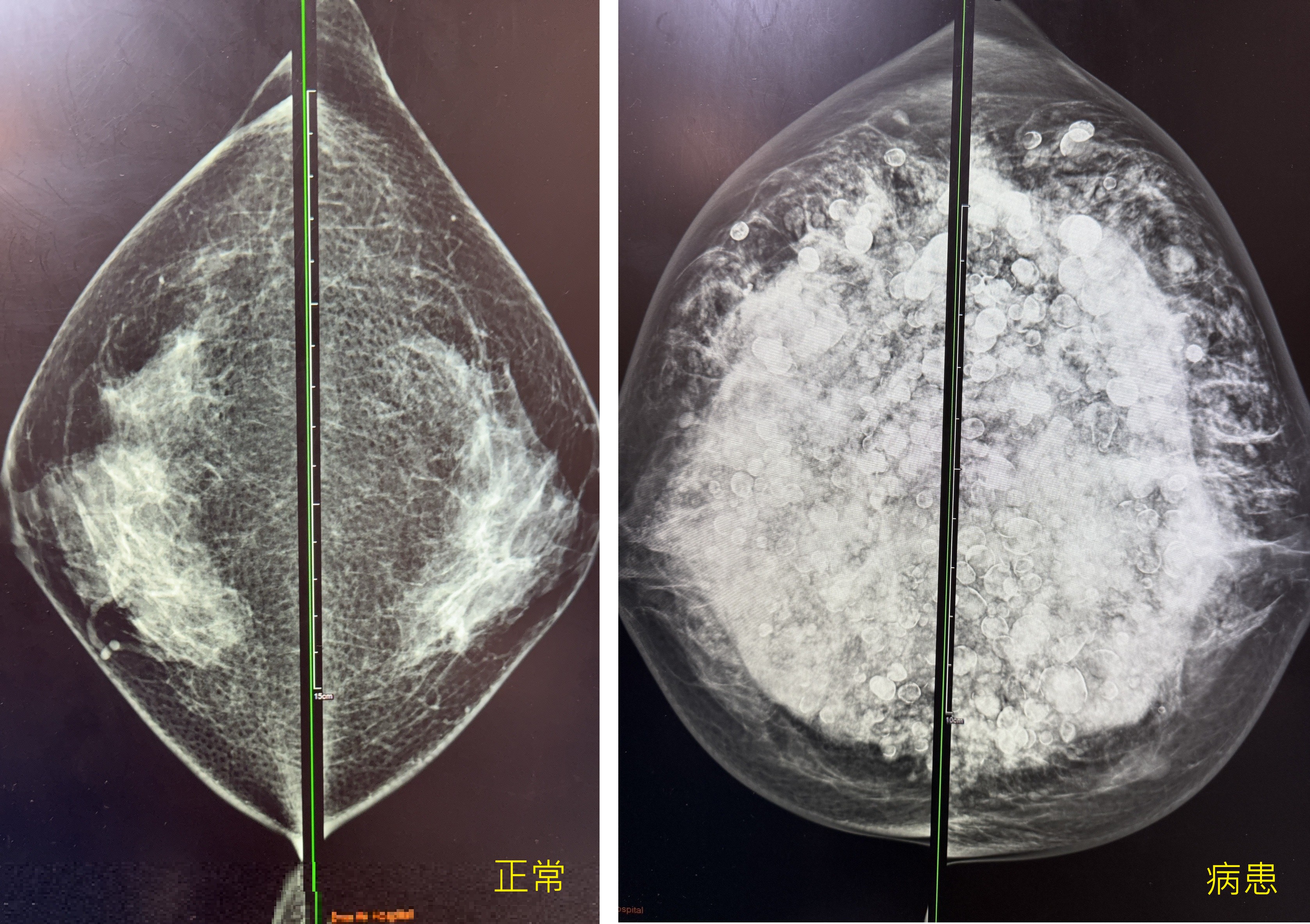 當年隆乳今全切!6旬婦乳房變形發臭 醫:小針隆乳恐致癌 當年隆乳今全切!6旬婦乳房變形發臭 醫:小針隆乳恐致癌