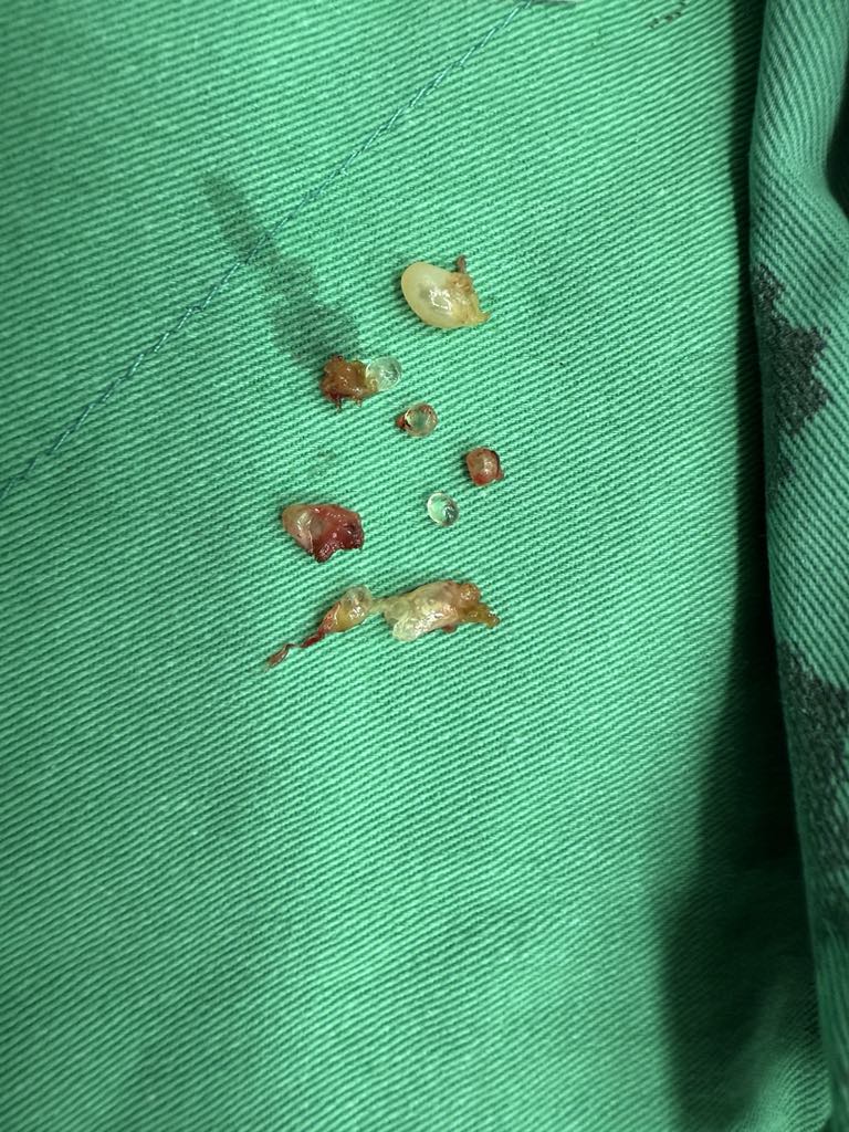 當年隆乳今全切!6旬婦乳房變形發臭 醫:小針隆乳恐致癌 當年隆乳今全切!6旬婦乳房變形發臭 醫:小針隆乳恐致癌