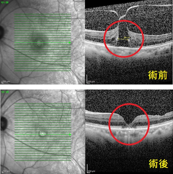 以為是白內障?真凶竟是黃斑部病變 醫:拖延恐失明 以為是白內障?真凶竟是黃斑部病變 醫:拖延恐失明