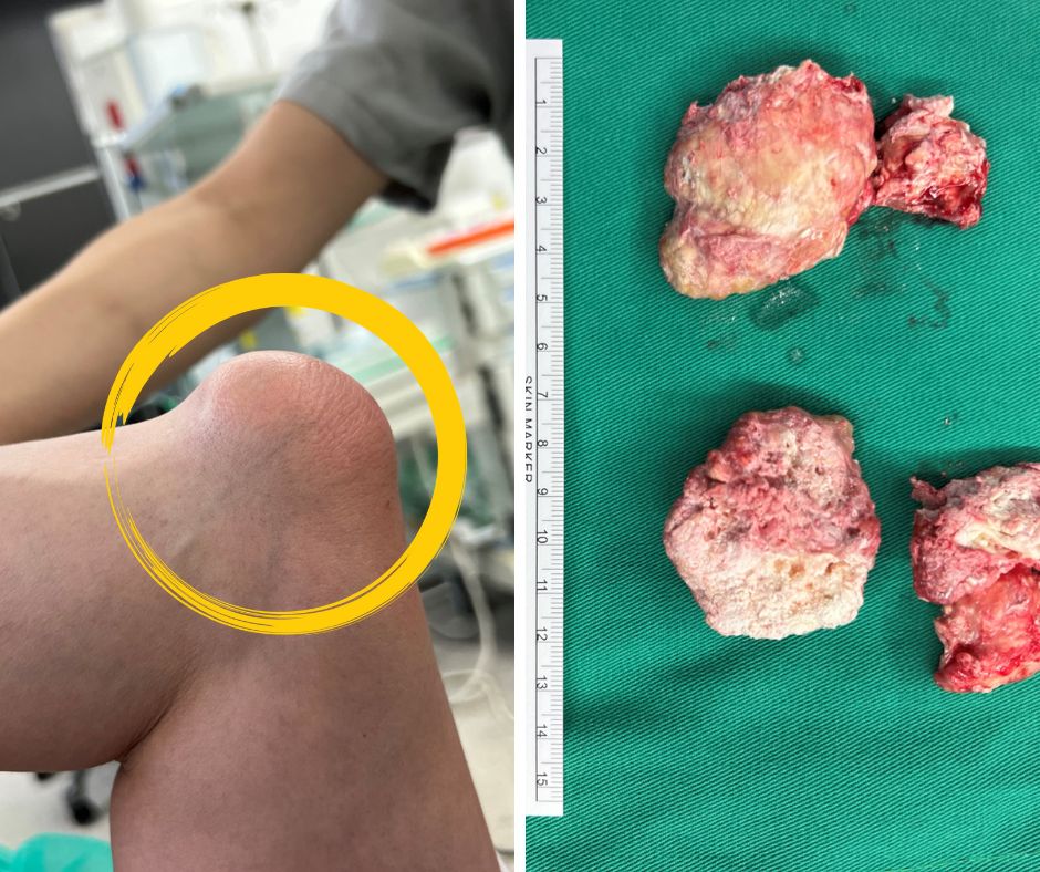 5旬男痛風石壓神經釀手麻!微創手術清石助好眠 醫:4狀況及早治 5旬男痛風石壓神經釀手麻!微創手術清石助好眠 醫:4狀況及早治