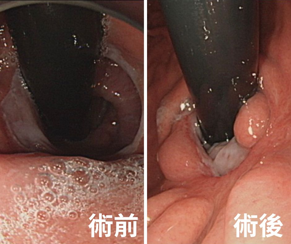 胃食道逆流十幾年夜夜難平躺 6旬男接受內視鏡燒灼術終睡好