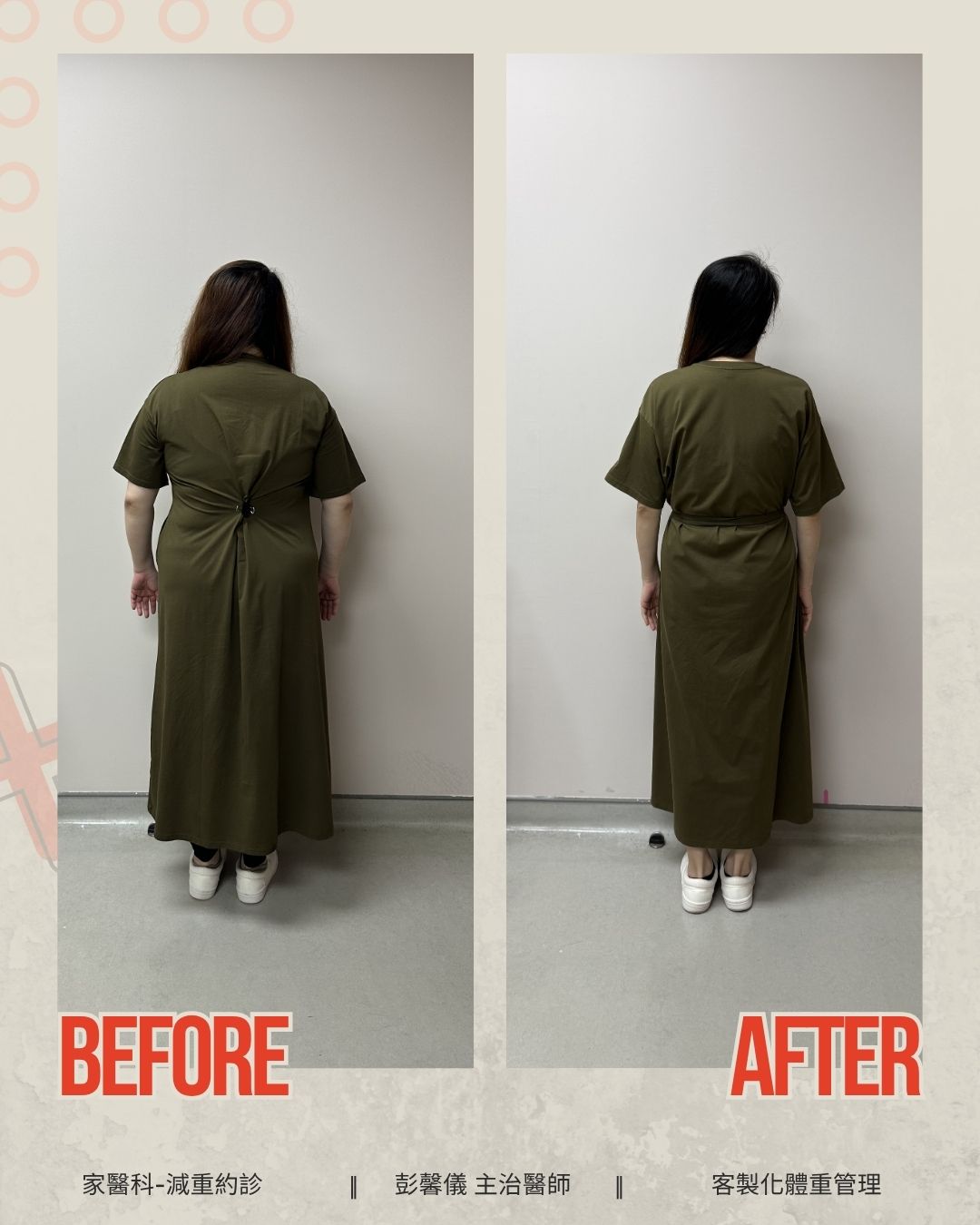 38歲女教師減重逾30公斤卻狂掉髮 醫提醒:瘦身別把營養也瘦掉 38歲女教師減重逾30公斤卻狂掉髮 醫提醒:瘦身別把營養也瘦掉