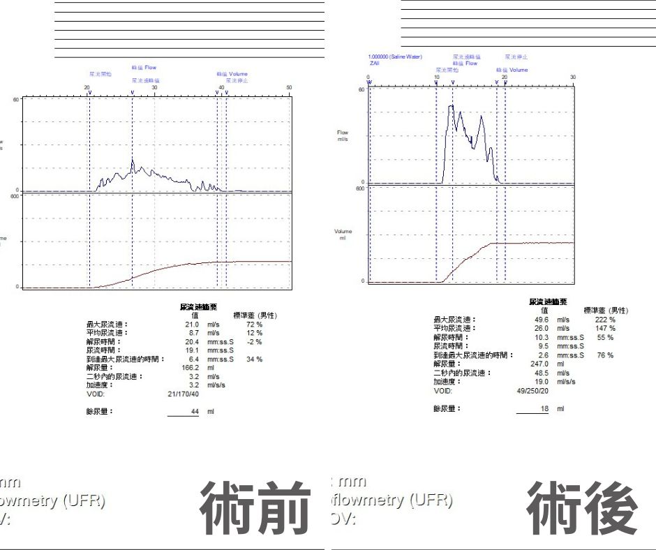 攝護腺肥大逾百克如拳頭！藍光雷射助六旬翁暢快解尿
