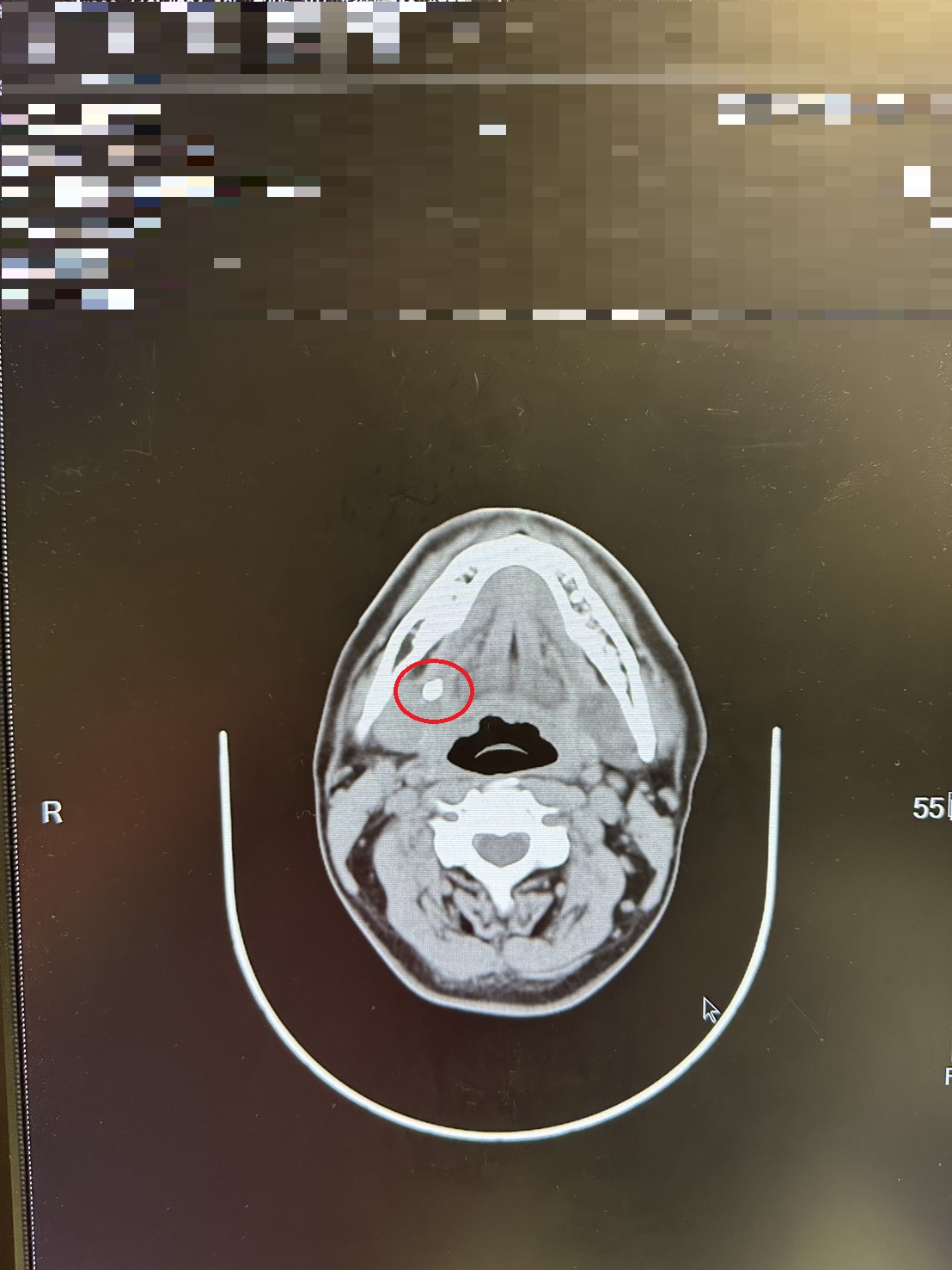壯男下巴腫竟是結石 微創手術精準取石不留疤！醫籲：除了多喝水 更要注意下半身