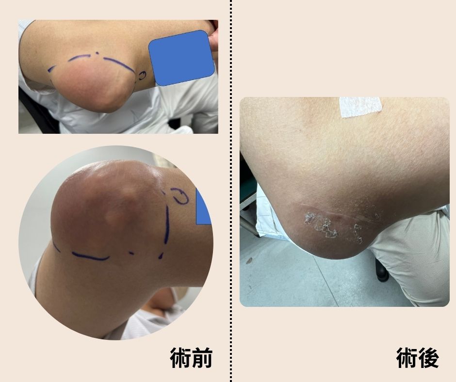 手肘痛風石手術像開盲盒,1顆變10幾顆!醫提三招保關節 手肘痛風石手術像開盲盒,1顆變10幾顆!醫提三招保關節