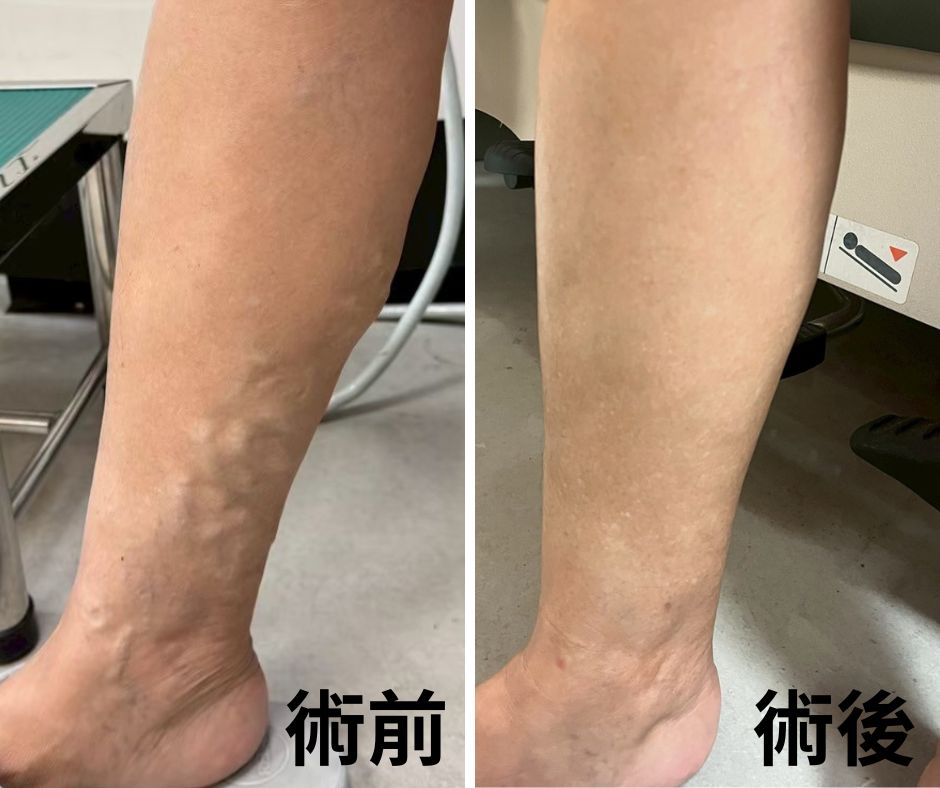 浮腳筋不痛不用管？6旬婦忍30年突腫痛！醫：血栓風險高5.3倍