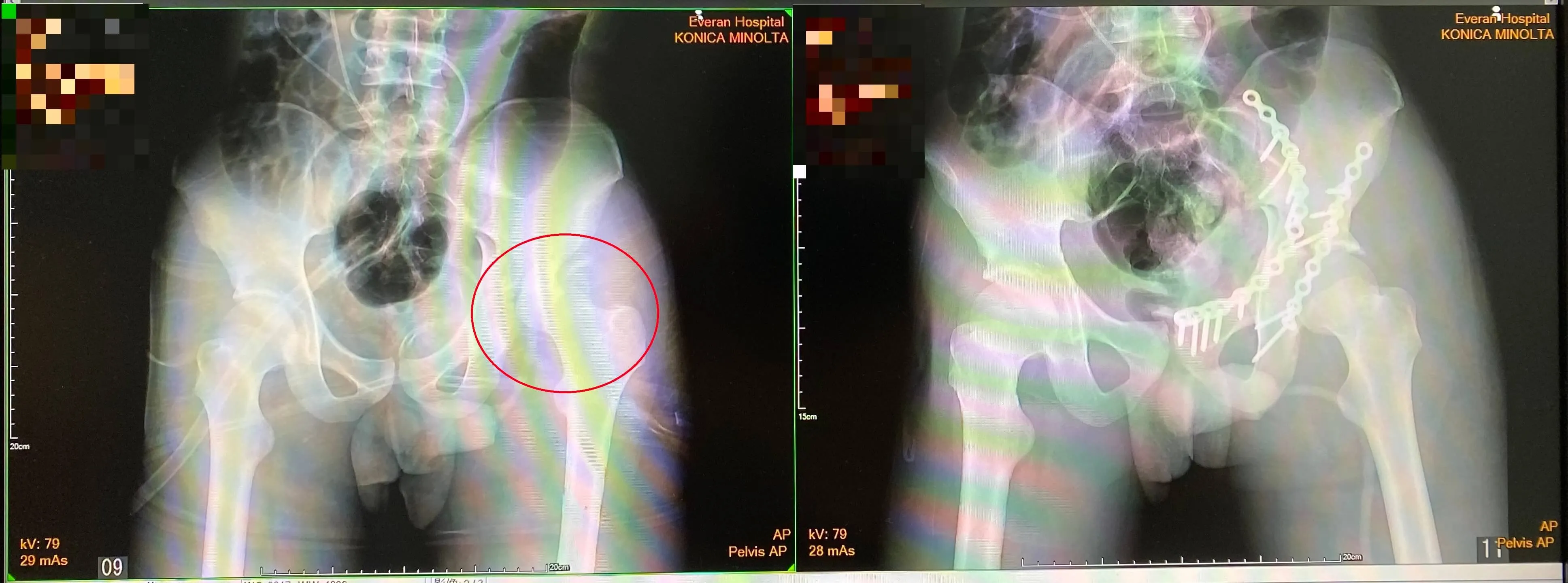 車禍髖臼骨折 微創骨折復位固定術助恢復行走