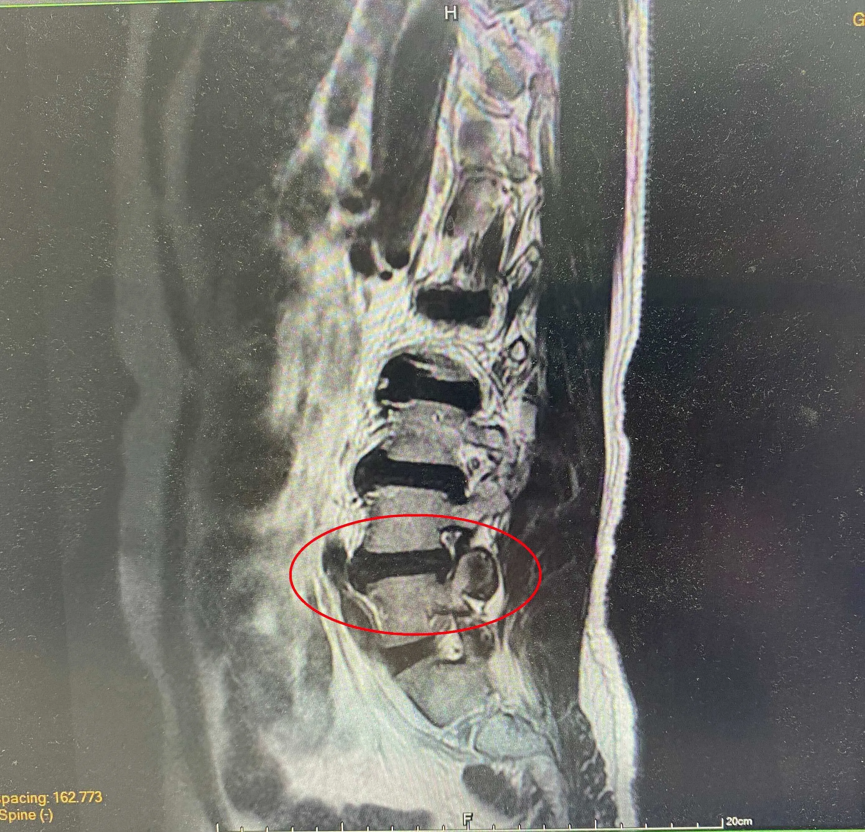 腰椎退化輪椅代步 脊椎內視鏡手術讓5旬男能自行行走