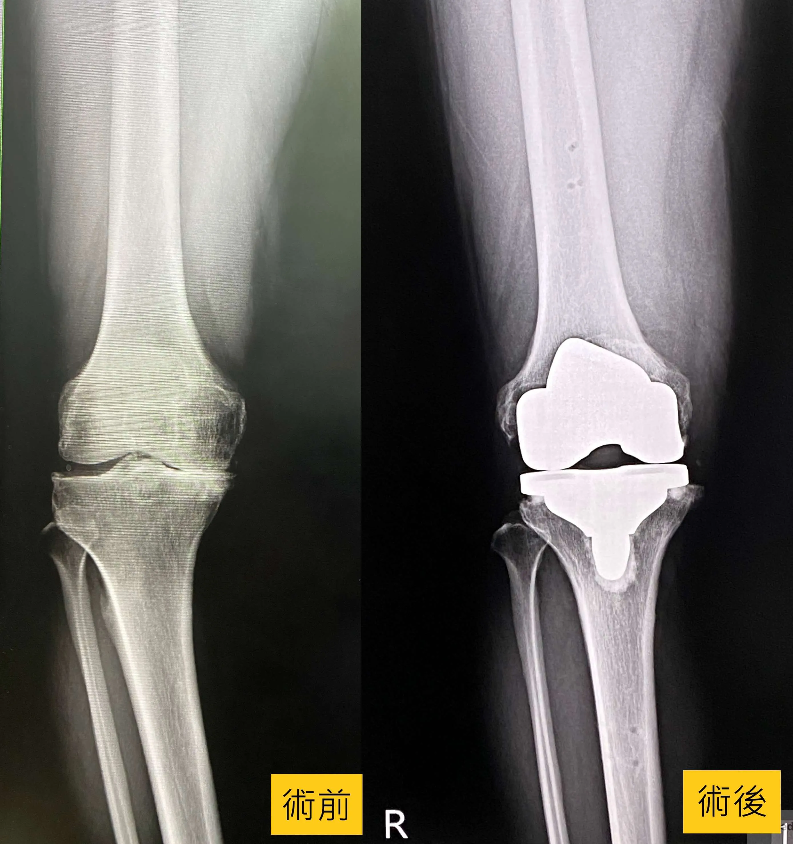 膝關節痛苦不堪 MAKO機器手臂解套