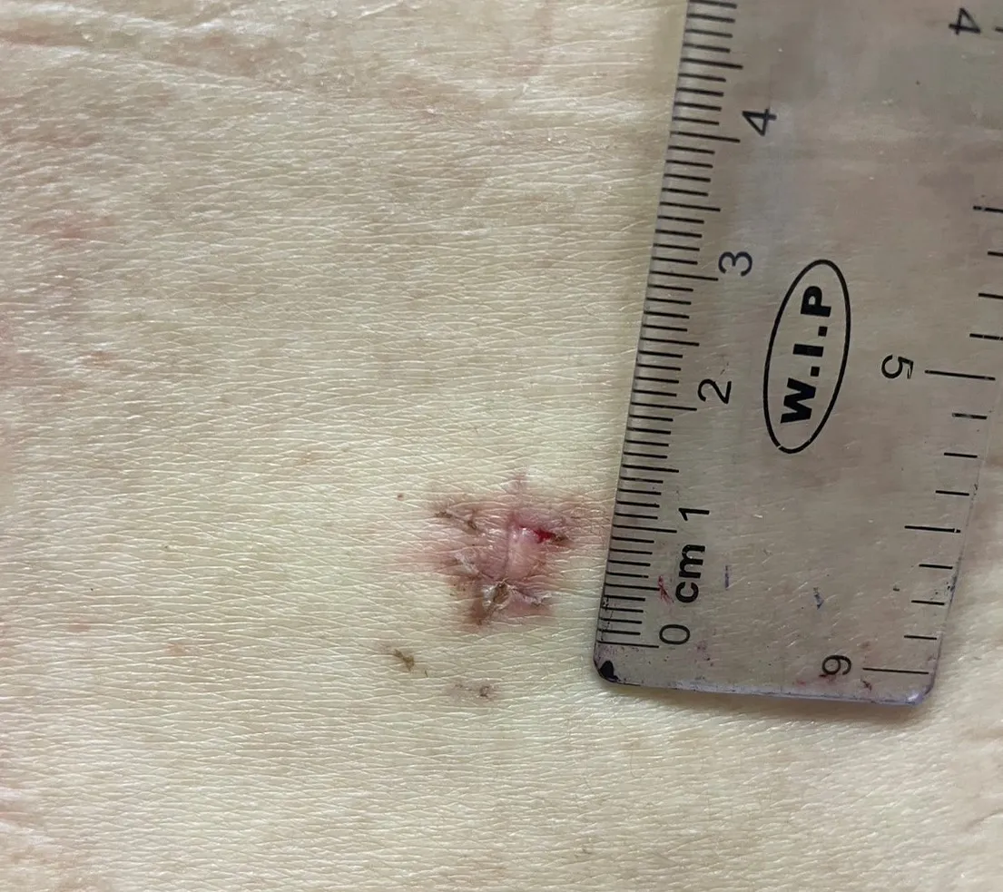 一公分傷口解決椎間盤突出!脊椎內視鏡手術擺脫庝痛困擾