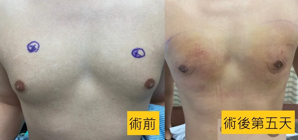 胸部突出超自卑 竟是「男性女乳症」