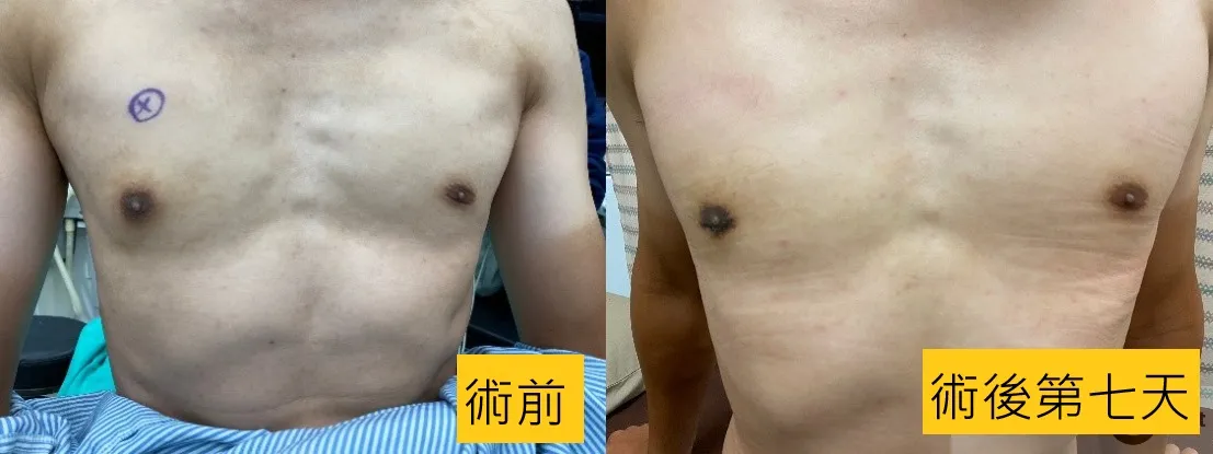 胸部突出超自卑 竟是「男性女乳症」