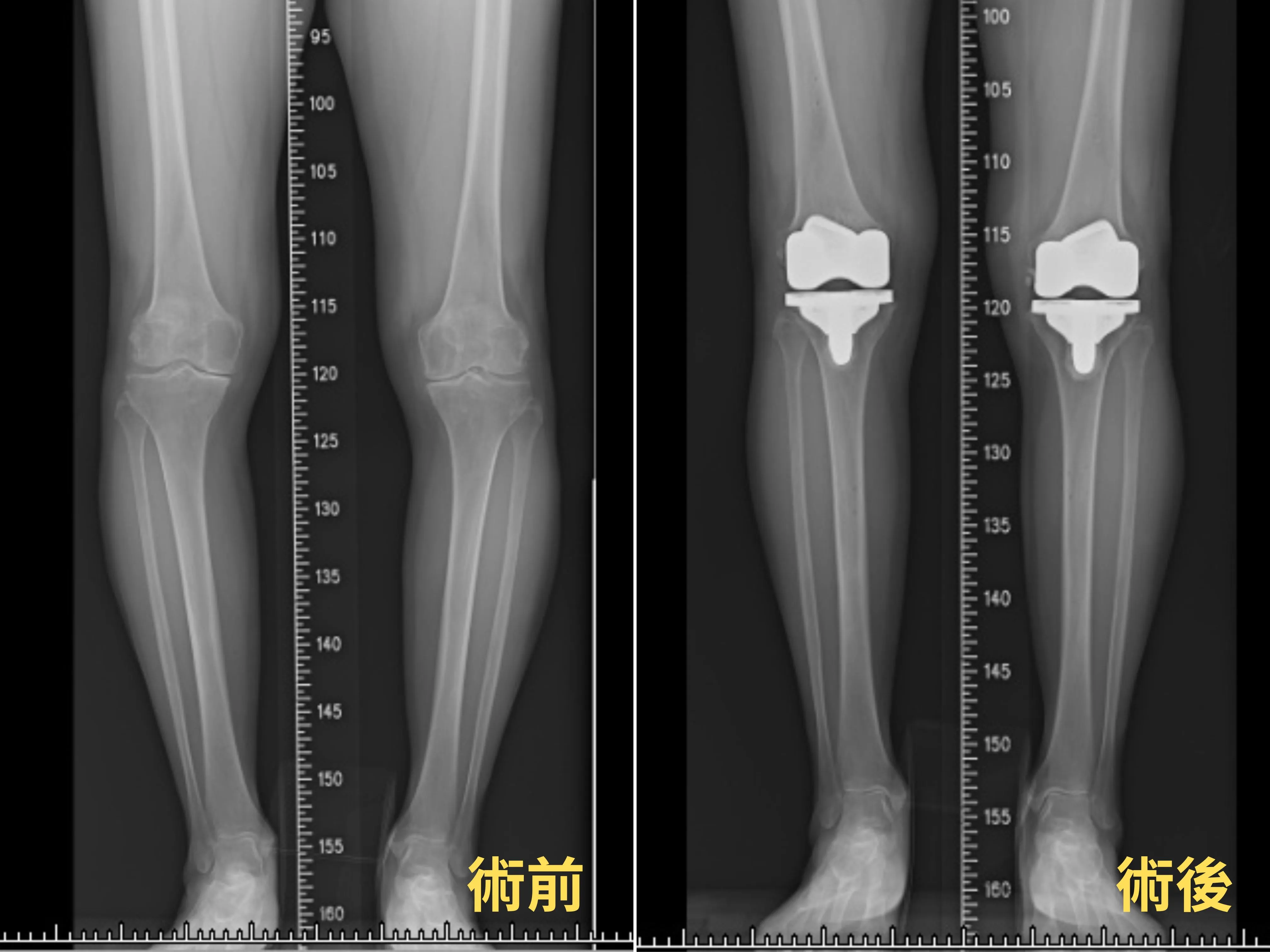 機器手臂雙膝關節置換術，助7旬婦重拾健步如飛