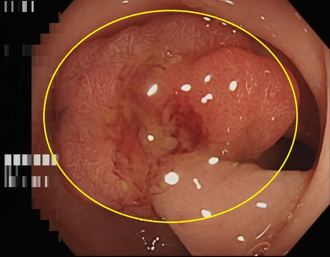 1.5公分瘜肉藏玄機 台中5旬婦靠定期篩檢救命!