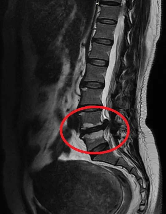 5旬居服員長期搬抬導致椎間盤突出,內視鏡手術助她速返崗位!