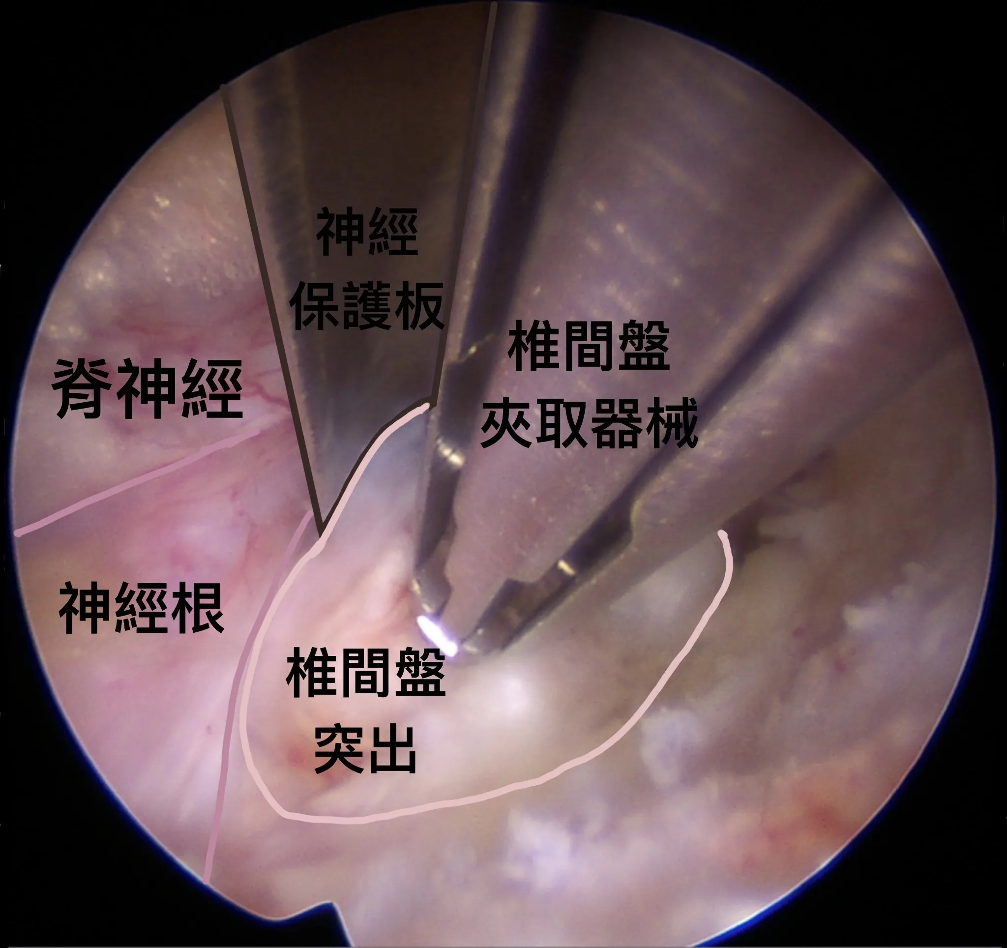 5旬居服員長期搬抬導致椎間盤突出,內視鏡手術助她速返崗位!