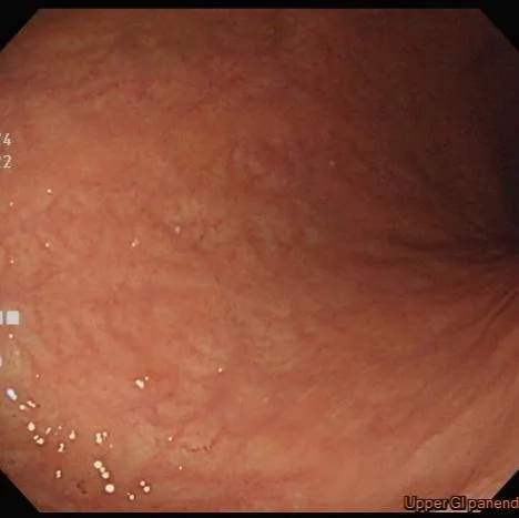 臉色蒼白、食慾差當心!小心是自體免疫性胃炎找上門