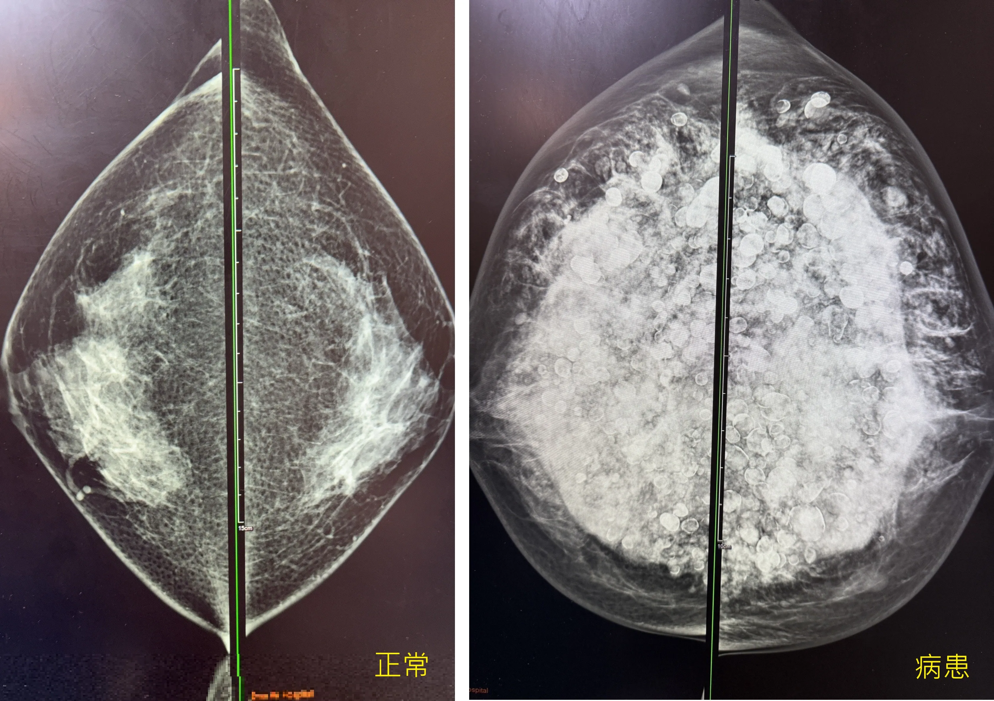 當年隆乳今全切!6旬婦乳房變形發臭 醫:小針隆乳恐致癌