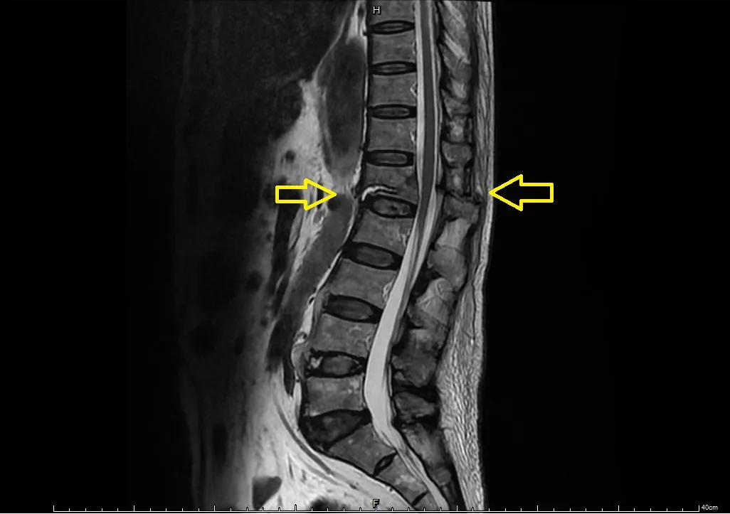 7旬翁背痛竟是危險骨折!僵直性脊椎炎惹禍