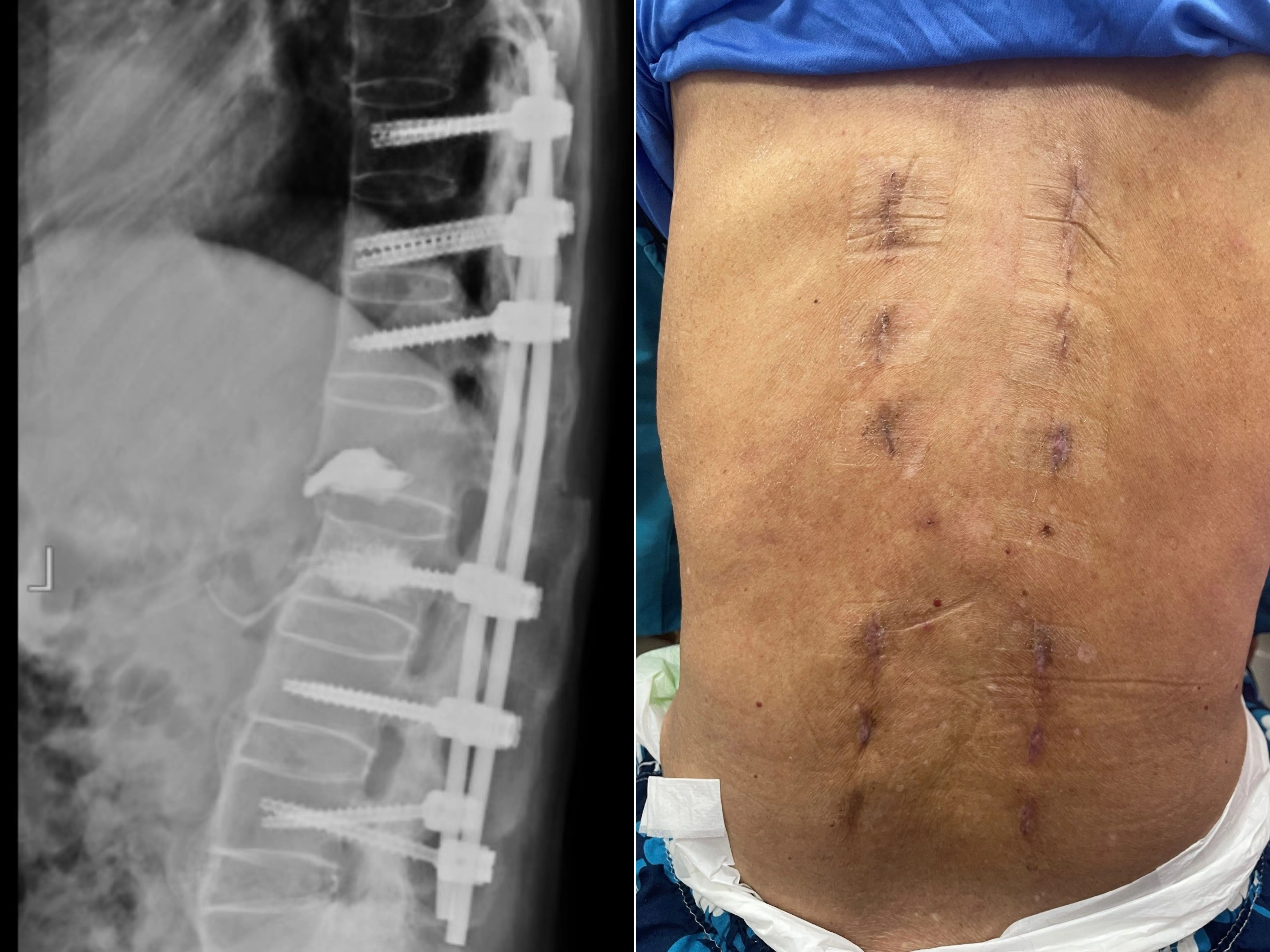 7旬翁背痛竟是危險骨折!僵直性脊椎炎惹禍