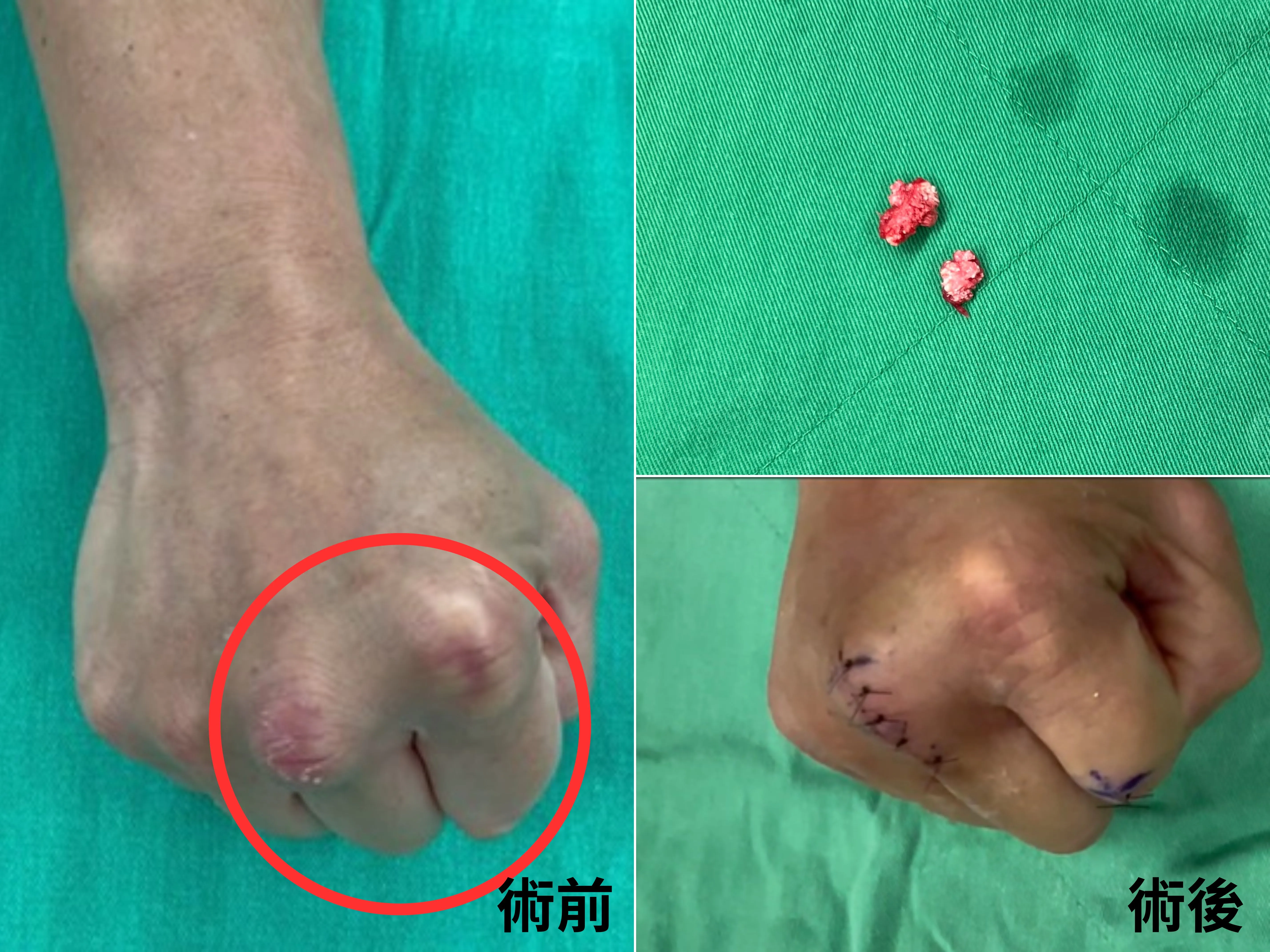 竹科工程師敲鍵盤卡卡 微創超音波刀清痛風石解困！