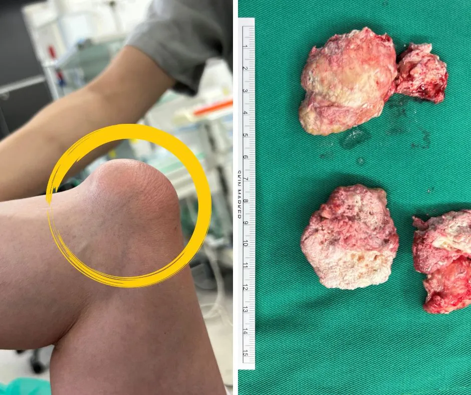 5旬男痛風石壓神經釀手麻!微創手術清石助好眠 醫:4狀況及早治